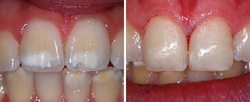 Amelogenesis Treatment