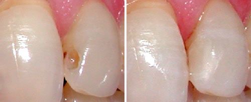 Cavity Preparation