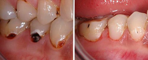 Cavity Preparation