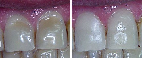 Enamel Erosion Treatment