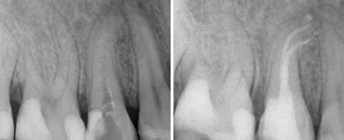 Endodontic Treatment