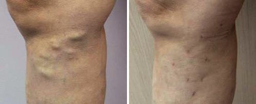 Endovascular Laser Ablation