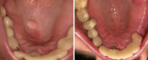 Fibroma Removal