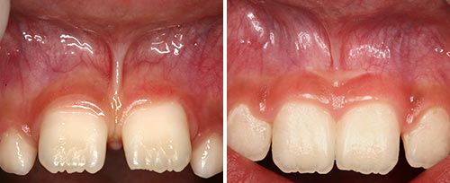 Frenectomy Treatment