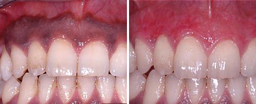 Gum Pigmentation Removal