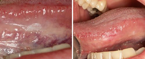 Leukoplakia Treatment