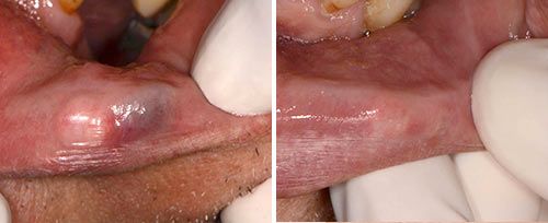 Tratamiento de Hemangioma