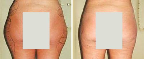 Laser Lipolysis