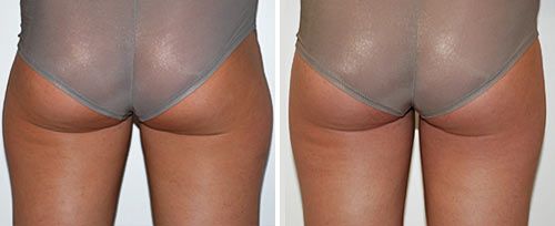 Laser Lipolysis