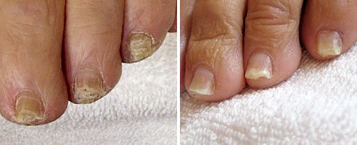 Onychomycosis Treatment