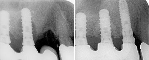 Peri-implantitis