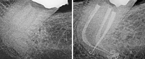 Endodontic Treatment