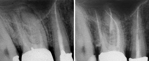 Endodontic Treatment