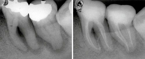 Endodontic Treatment