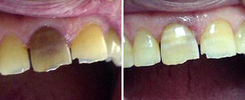 Tooth Whitening