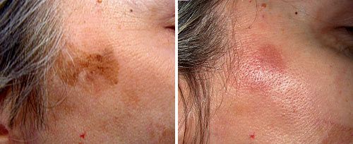 Actinic Keratosis Treatment