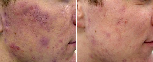 Active Acne Treatment