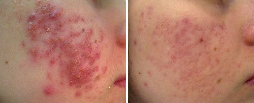 Active Acne Treatment