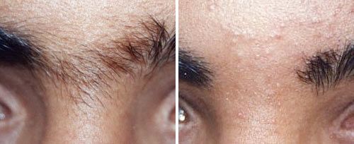 Permanent Hair Reduction