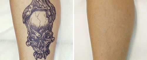 Tattoo Removal